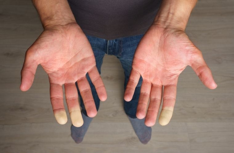 Raynaud hastalığı (sendromu) nedir.