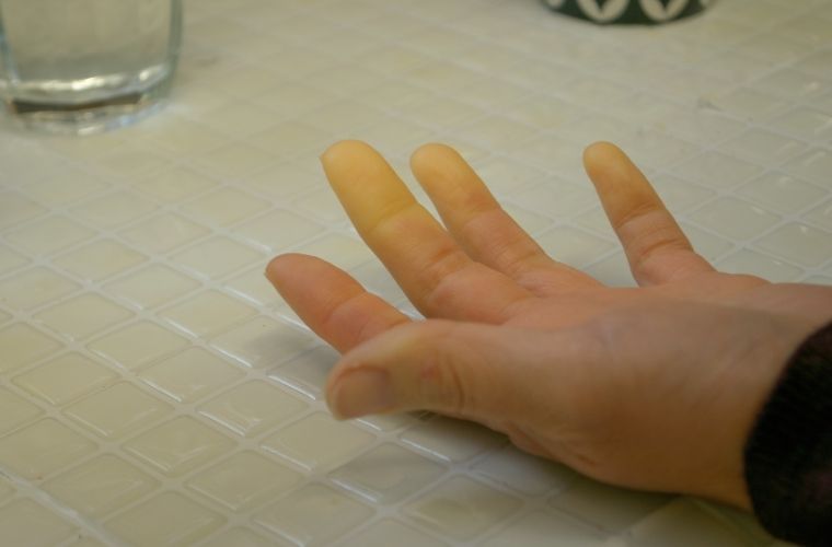 Raynaud hastalığının belirtileri. Raynaud sendromu nasıl anlaşılır.