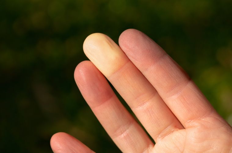 Raynaud hastalığının nedenleri. Raynaud sendromunun sebepleri.