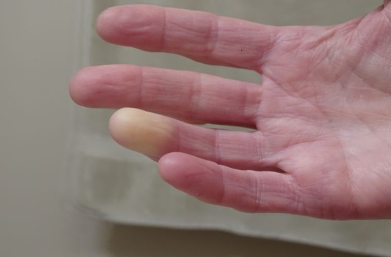 Raynaud hastalığının tedavisi. Raynaud sendromu tedavi yöntemleri.