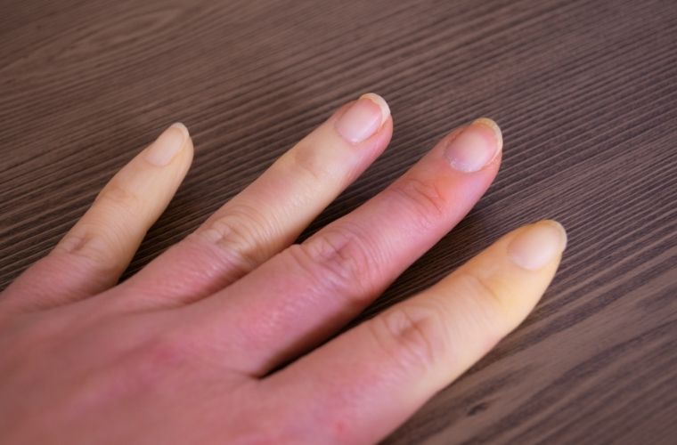 Raynaud hastalığının teşhisi.