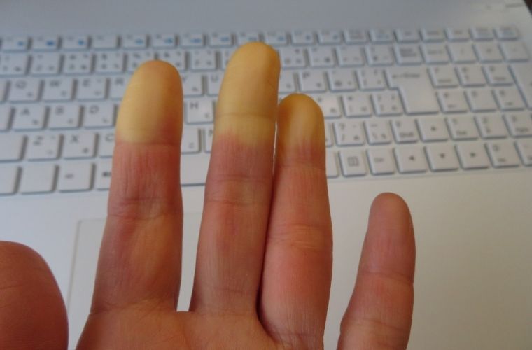 Raynaud hastalığının türleri ve çeşitleri.