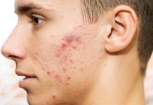 Rüyada Sivilce Görmek Ne Anlama Gelir? Rüyada sivilce görmek, rüyada yüzünde veya vücudunda sivilce çıktığını fark etmek, rüyada iltihaplı sivilce görmek.