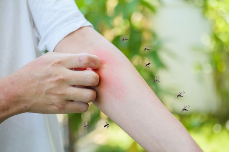 Sivrisinek ısırığına bağlı alerjik belirtileri ve cilt reaksiyonlarını gösteren görsel
